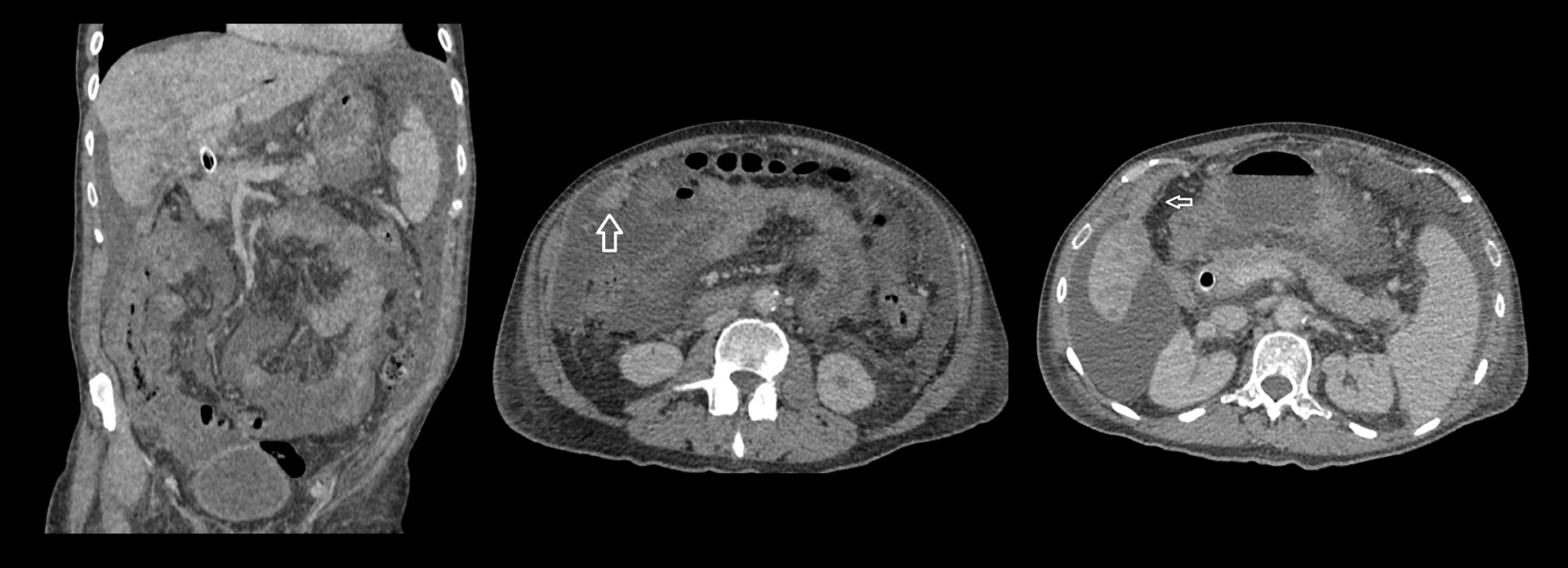 Carcinomatose Peritoneal